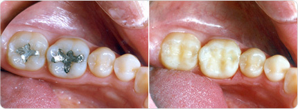 Amalgame ou composite recette pansement dentaire maison 2-3